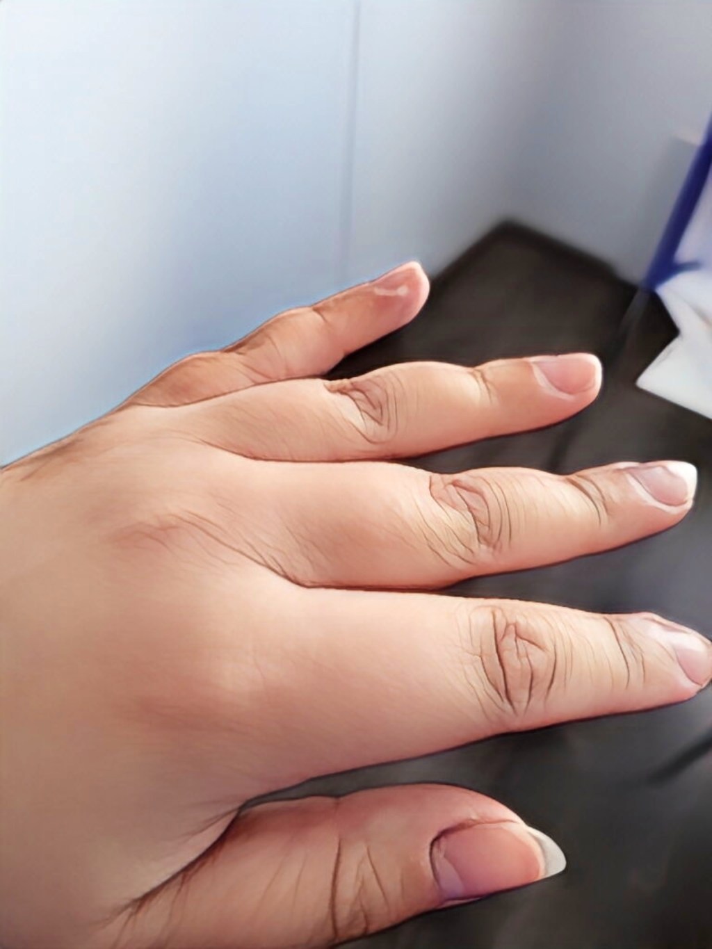 Nivelpsoriasis ja sen&nbsp;ensioireet